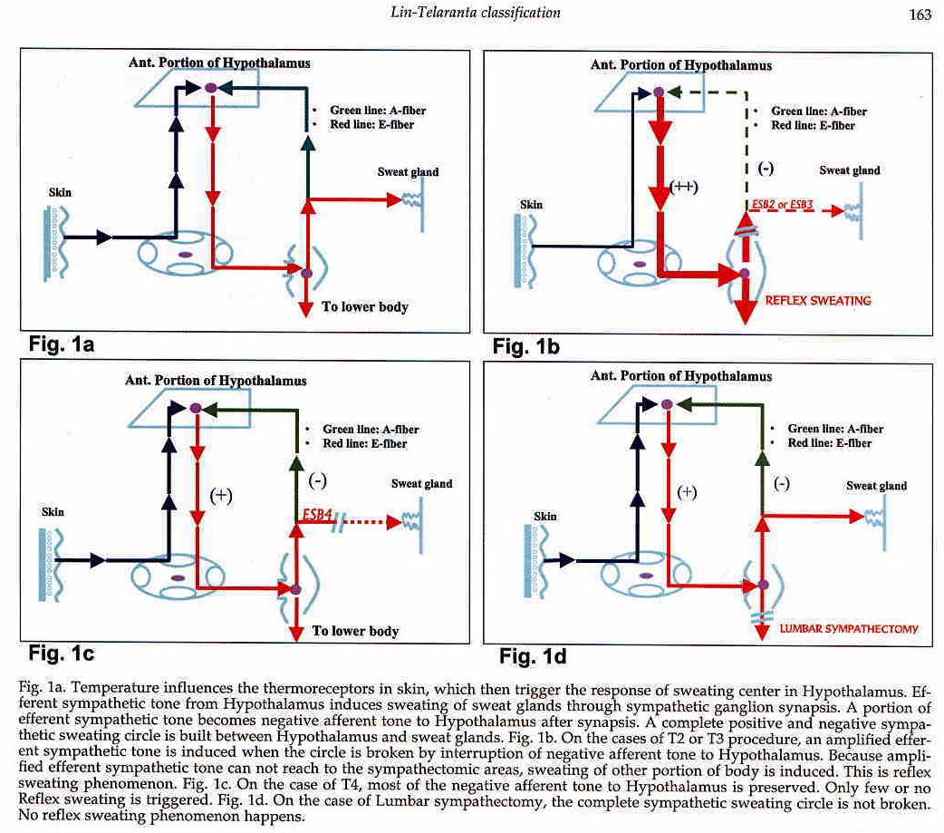 Second, how can the absent reflex sweating be explained with ESB4 and ...