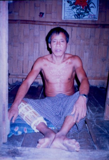 Victim of Bangladesh Army Torture
