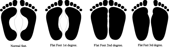 flat shoes of  treated   This the is more Flat feet problems for one  children Feet  (Pronated) common
