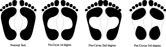 feet  for basic but different, All into shoes fall supinated feet types: are most three
