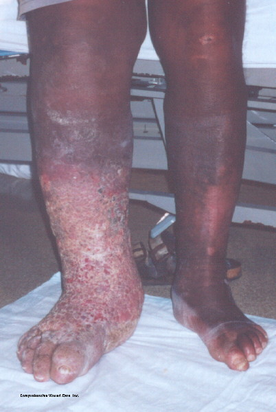 legs infection #10