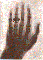 Bertha's hand