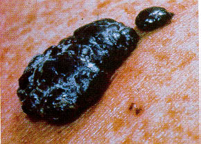 Image of a serious melanoma.  It looks like a big puffy growth on top of the skin.  Also looks like a big bumpy mole on top of the skin.