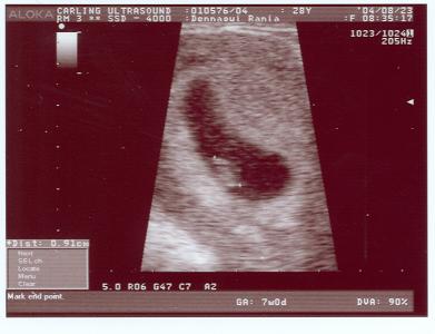Baby Ultrasound - Aug 2004