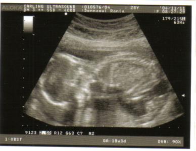 Baby Ultrasound - Nov 2004