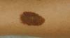 birthmark