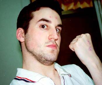 Dunc showing his mozzie bites