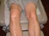 Edema or swelling of the knee 25th 2005