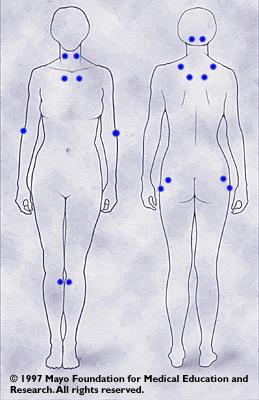 Mayo's 18 Trigger points Of Fibromyalgia