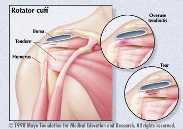 mayo's Rotator cuff 