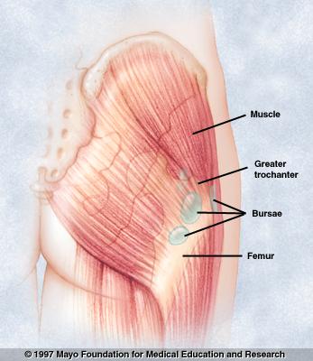 Bursitis 