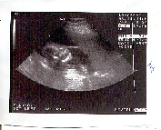 Tvilling II p&aring; f&ouml;rsta ultraljudet!