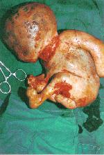 stone fetus (Lithopedion), abdominal conceptus dies and becomes calcified.