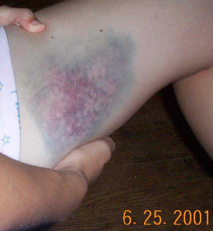 Bruise