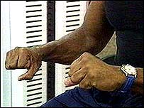 Stroke patient with paralysis of the hands