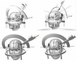 Functional neurosurgery