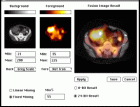 Fusion of CT and SPECT images - click to enlarge