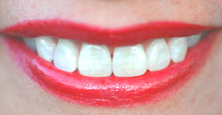 Dental treatment without pain