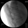 Thoracic facet injection - lateral