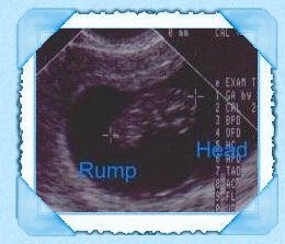 Ultrasound