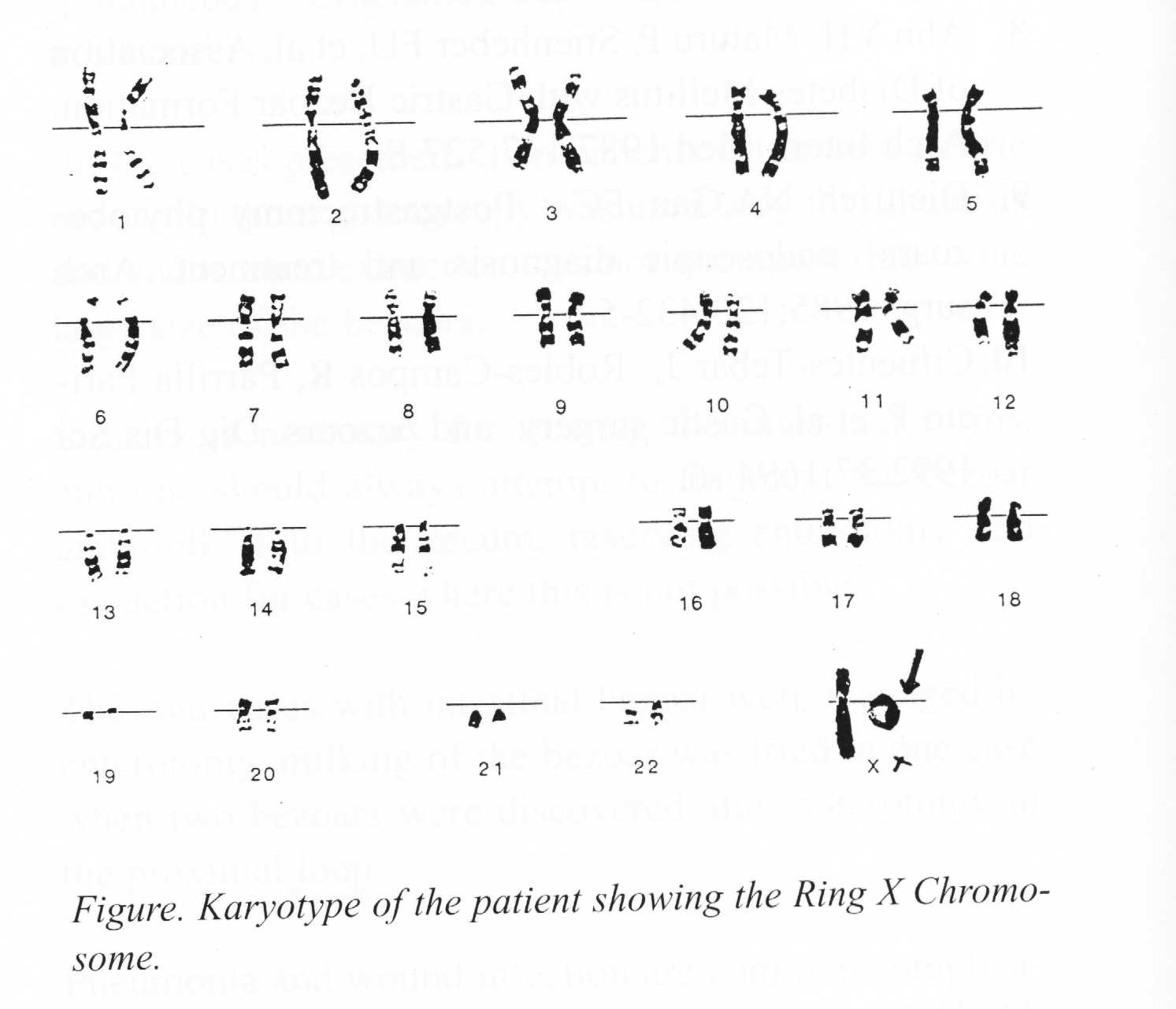 Ring20 Research & Support UK CIO - What exactly is a ring chromosome?  Chromosomes usually have a top and a bottom, but in a ring chromosome for  some reason a chromosome forms