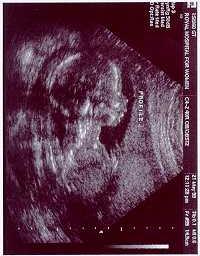 Søren's 19 week ultrasound