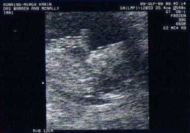 Imogen at 12 week scan