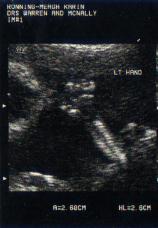 Heloise sucking her thumb in utero