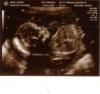 Baby boy's ultrasound