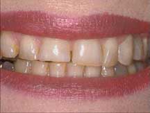 Sorriso antes do Clareamento