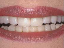 Sorriso ap�s o Clareamento