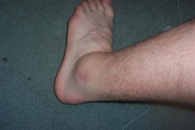 My Ankle